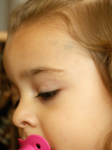 Shows more petechiae around her face (the one in her nose too), but more importantly shows the small bruise in her hairline above her left eye.